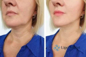 Double chin before and after Hi-Fu treatment 4 Book your double chin treatment Camden today! We are here to help!