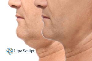 Double chin before and after Hi-Fu treatment 2 Double chin treatment Camden from Lipo Sculpt - feel more confident today!