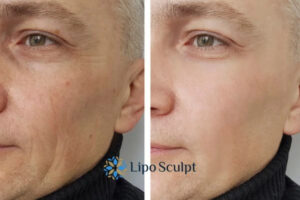 How to Fight Aging Symptoms 3 Fight Aging Symptoms Camden With HIFU and Morpheus8 Today!