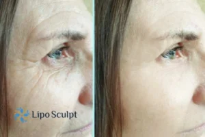 How to Fight Aging Symptoms 2 Do you want to Fight Aging Symptoms Camden? Contact Lipo Sculpt today!