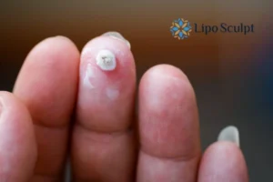 Cryopen Top 5 Treatable Conditions 4 Do you have a persistent wart of verruca that you cannot shit? Cryopen Camden treatment will work call us NOW!