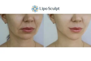 Explaining Total Skin Tightening Treatment And What It Can Do For You 2 Do you want to boost your self confidence? Give Morpheus8 Camden a try today!