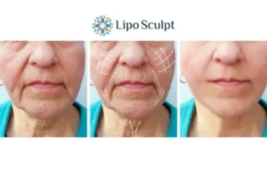 Explaining Total Skin Tightening Treatment And What It Can Do For You 3 Boost your confidence with Morpheus8 Camden call our team today!