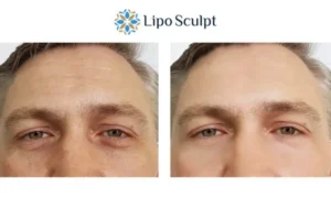 Explaining Total Skin Tightening Treatment And What It Can Do For You 6 Morpheus8 Camden book in today to find out more!