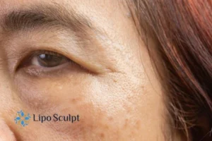 Cryopen: The Revolutionary Treatment for Age Spots Unveiled 2 Are age spots Camden giving you low self esteem? Contact us today!
