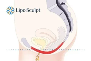 Pelvic Floor Chair Therapy 1 Pelvic Floor Chair Therapy Camden to treat incontinence.