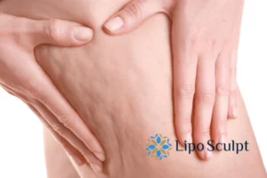 CoolSculpting for Legs: The Innovative Approach to Redefining Your Legs 5 Start your journey today book your coolsculpting treatment Camden online today!