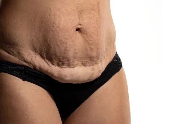 Lost the Weight but Not the Loose Skin? 1 image of womans stomach after weight loss showing loose skin Camden